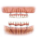 オールオン4(即日インプラント修復)